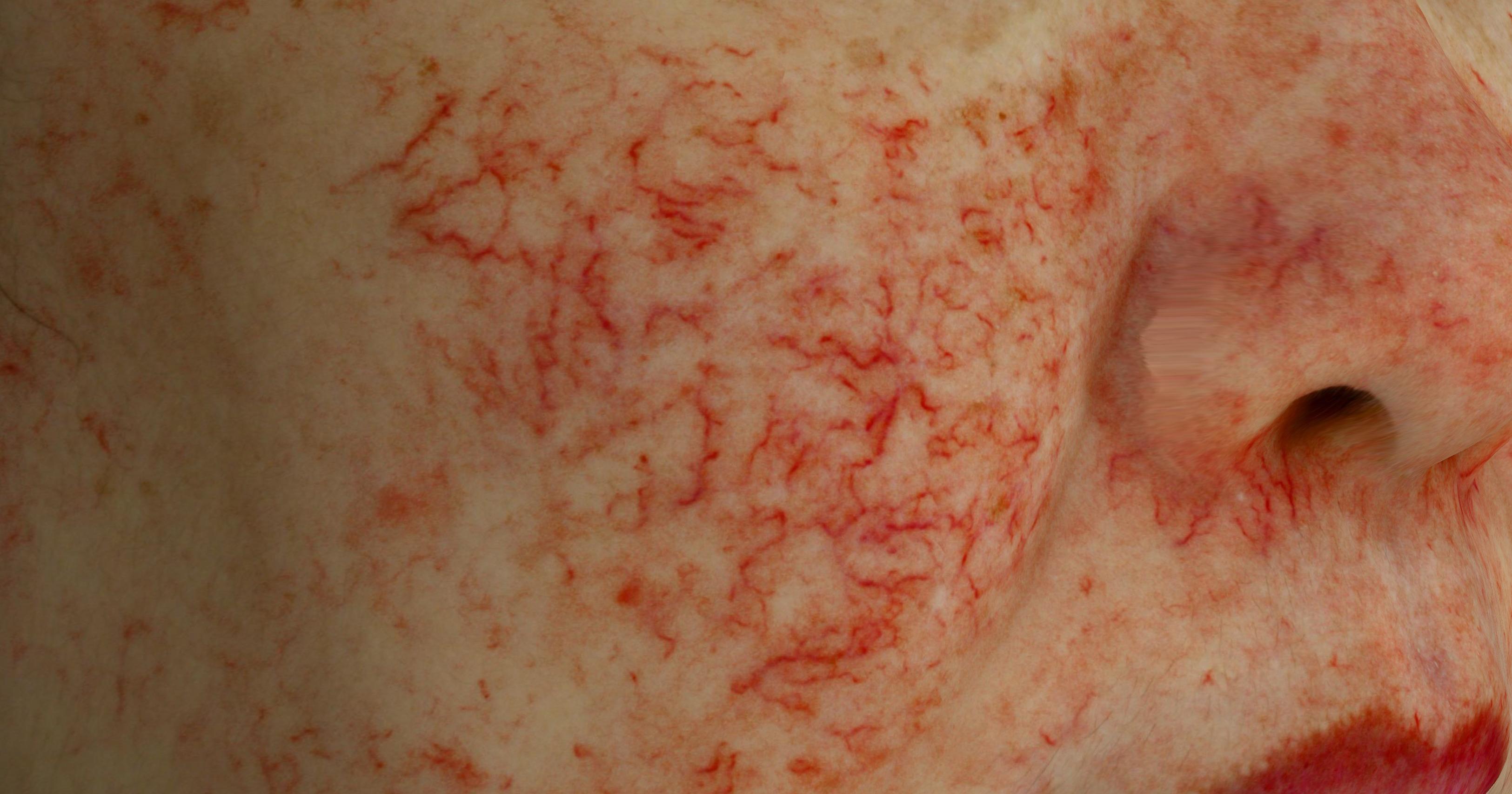Inflammation & skin sensitivity: Telangiectasia
