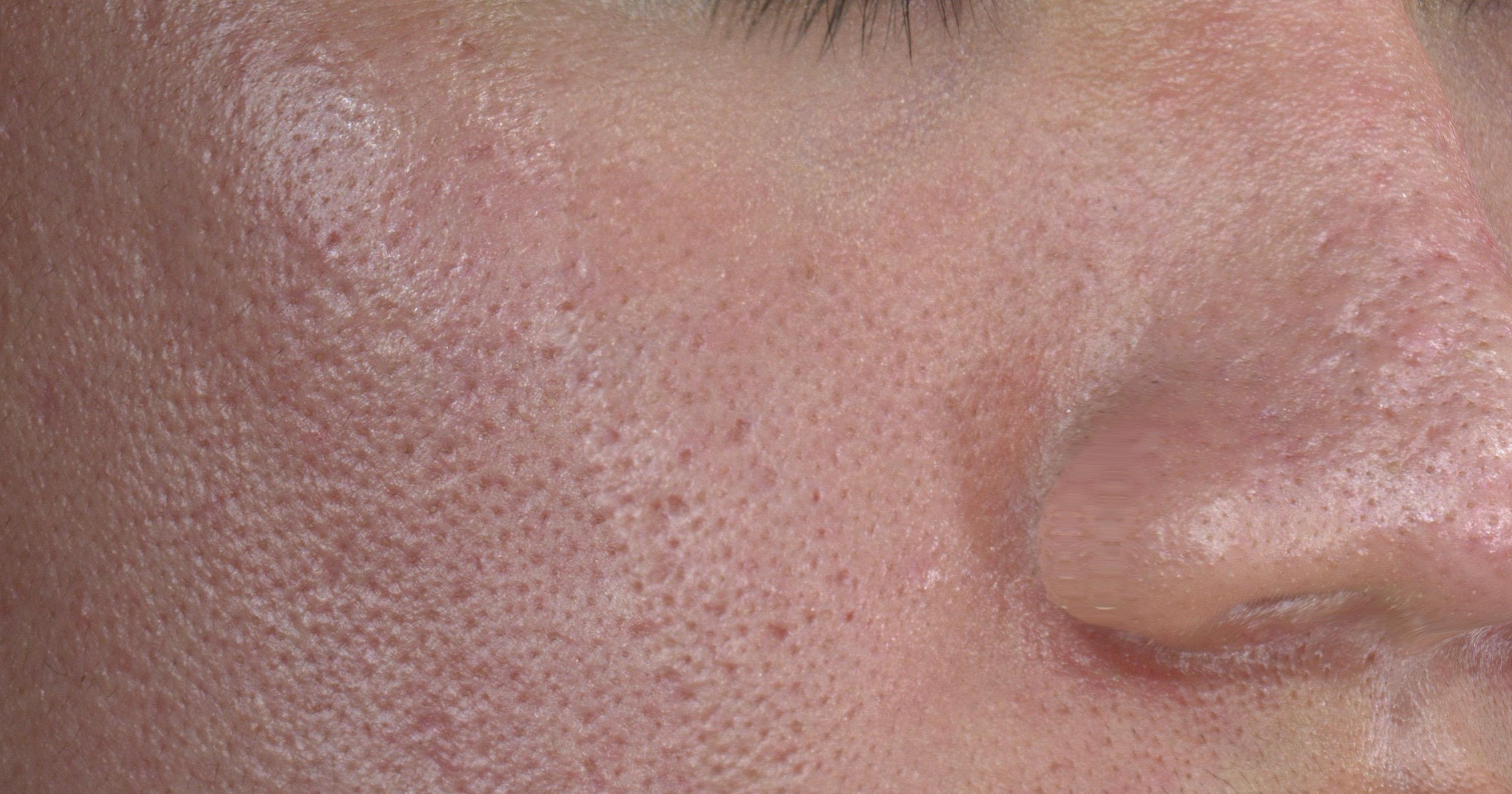 Skin condition & texture: Parallel-polarized view